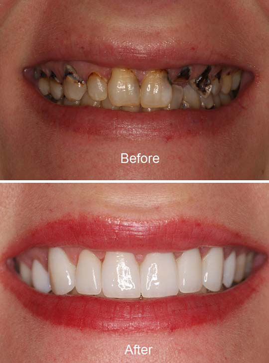 A smile makeover is a comprehensive dental examination and correction plan that includes two or more dental procedures.