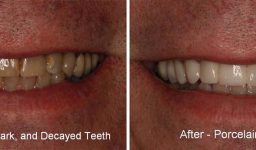 Dental Veneers Are The Easiest Way To Have The Perfect Smile
