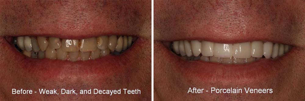 Dental Veneers Are The Easiest Way To Have The Perfect Smile