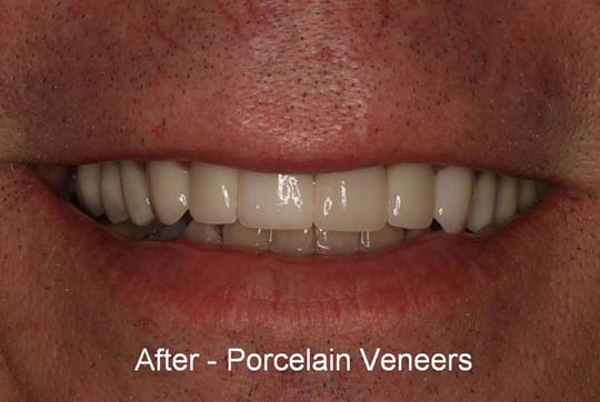After photo of patient with Dental Veneers