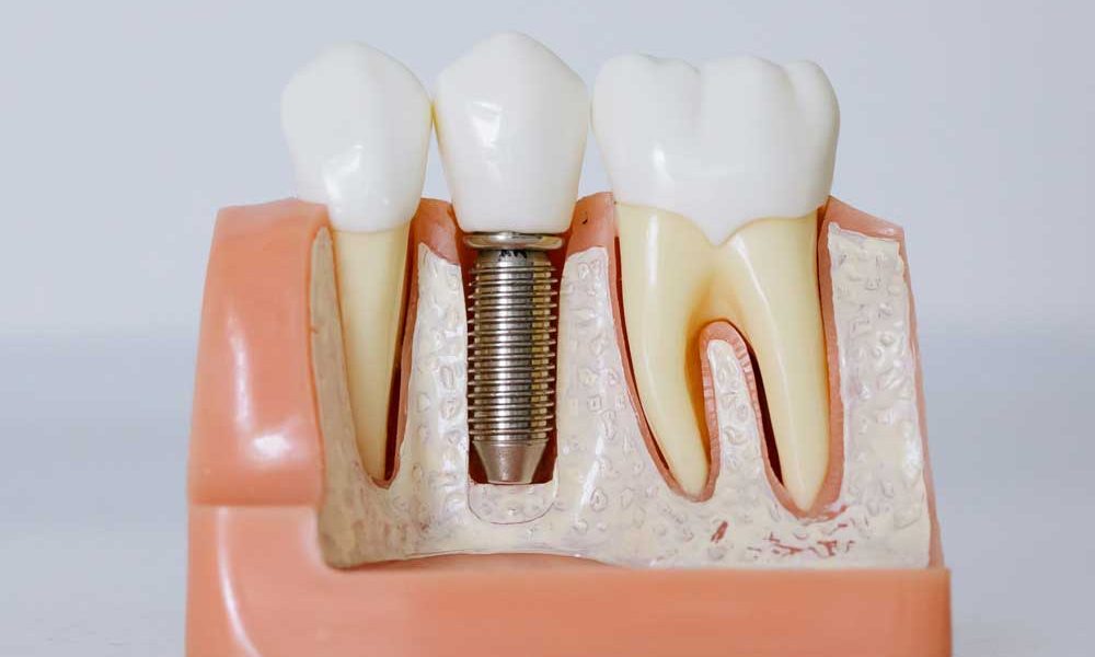 Dental Implants Are The Best Tooth Replacement Option For Most People