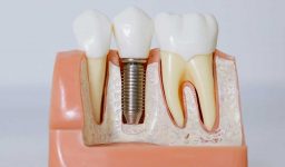 Dental Implants Are The Best Tooth Replacement Option For Most People