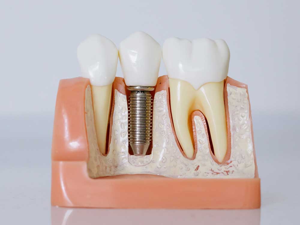 Dental Implant plastic model