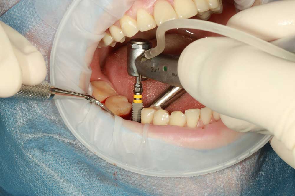 Dental patient receiving a Dental Implant