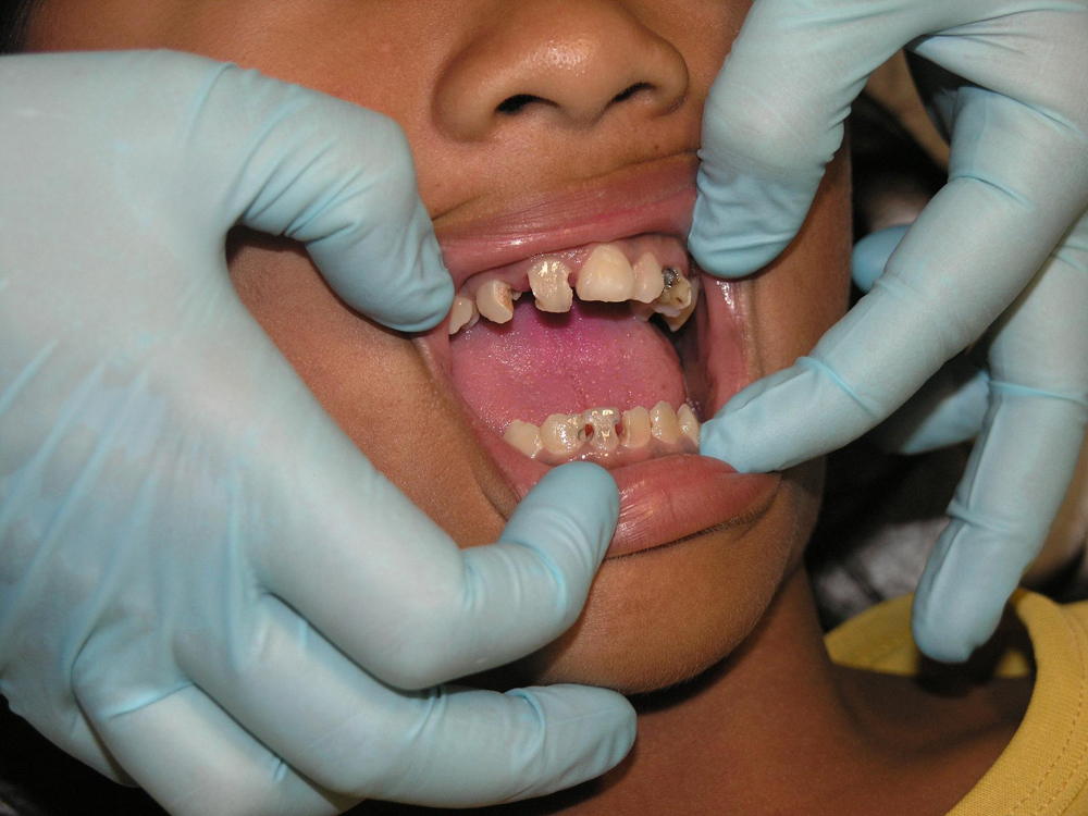Dental Crowns are a popular restoration method used to save natural teeth.