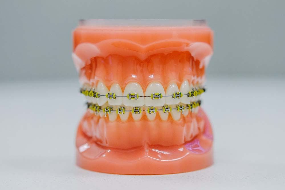 An example of dental braces for all teeth.