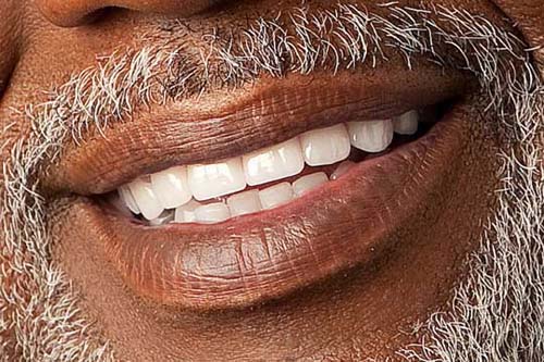 Dental Veneers Are Key To A Beautiful Smile