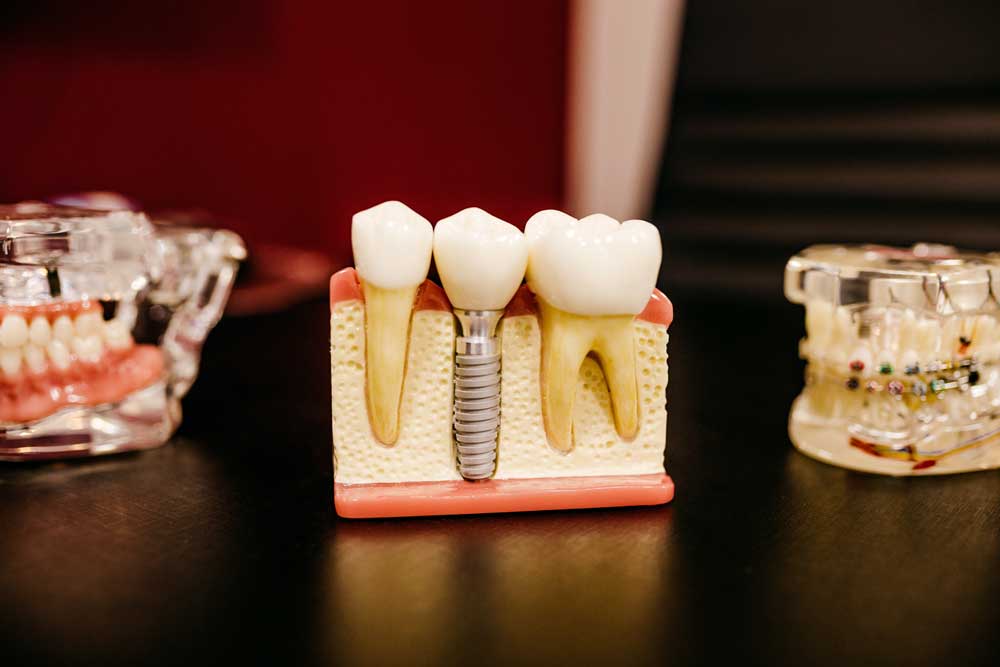 New Technology Improves Tooth Implants and Cosmetic Dentistry